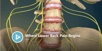Customized Physical Therapy Can Ease Lower Back Pain