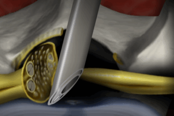 Intralaminar Lumbar Microendoscopic Discectomy