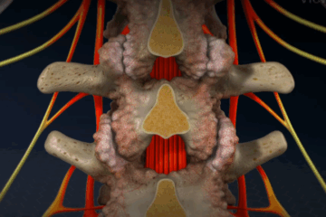 Laminectomy