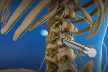Lumbar Sympathetic Block