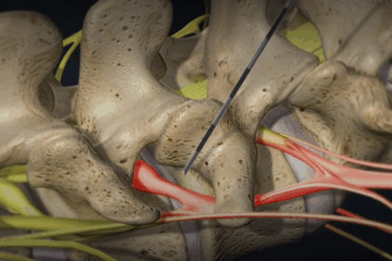Lumbar Transforaminal Epidural Steroid