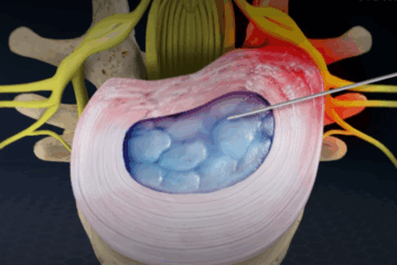 Microdiscectomy with Annuloplasty