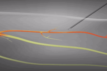 Radiofrequency Ablation (RFA)