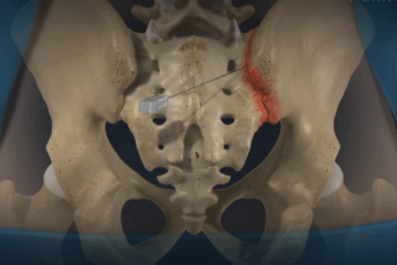 Sacroiliac Joint Steroid Injection