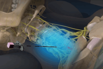 Stellate Ganglion Nerve Block