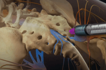 Epidural Steroid Injection