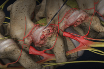 Facet Joint Injections