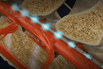Spinal Cord Stimulator